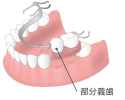 部分義歯（入れ歯）